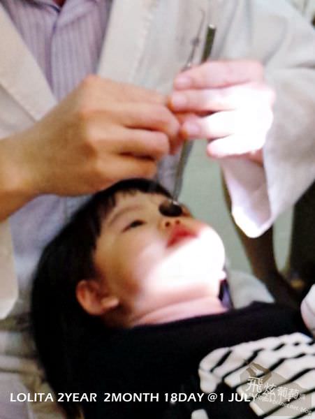 天母🔸蛀牙問題& 臼齒溝隙填補(兒童蛀牙處理)